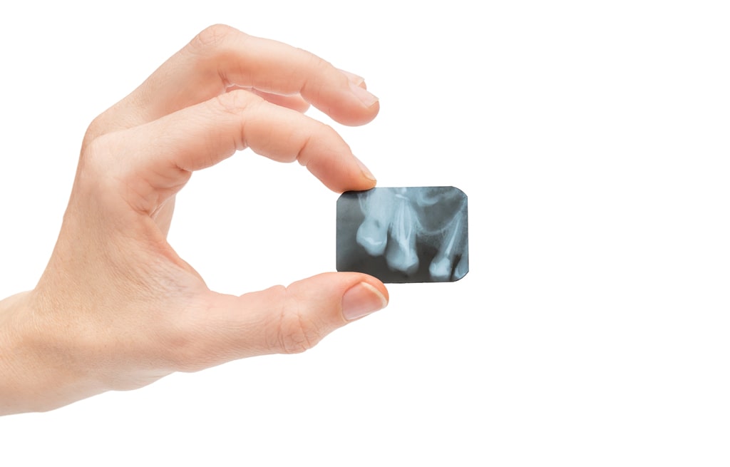 Endodontie Spezialist Bremen: Röntgenbild einer Gebissaufnahme Endodontie Spezialist Bremen