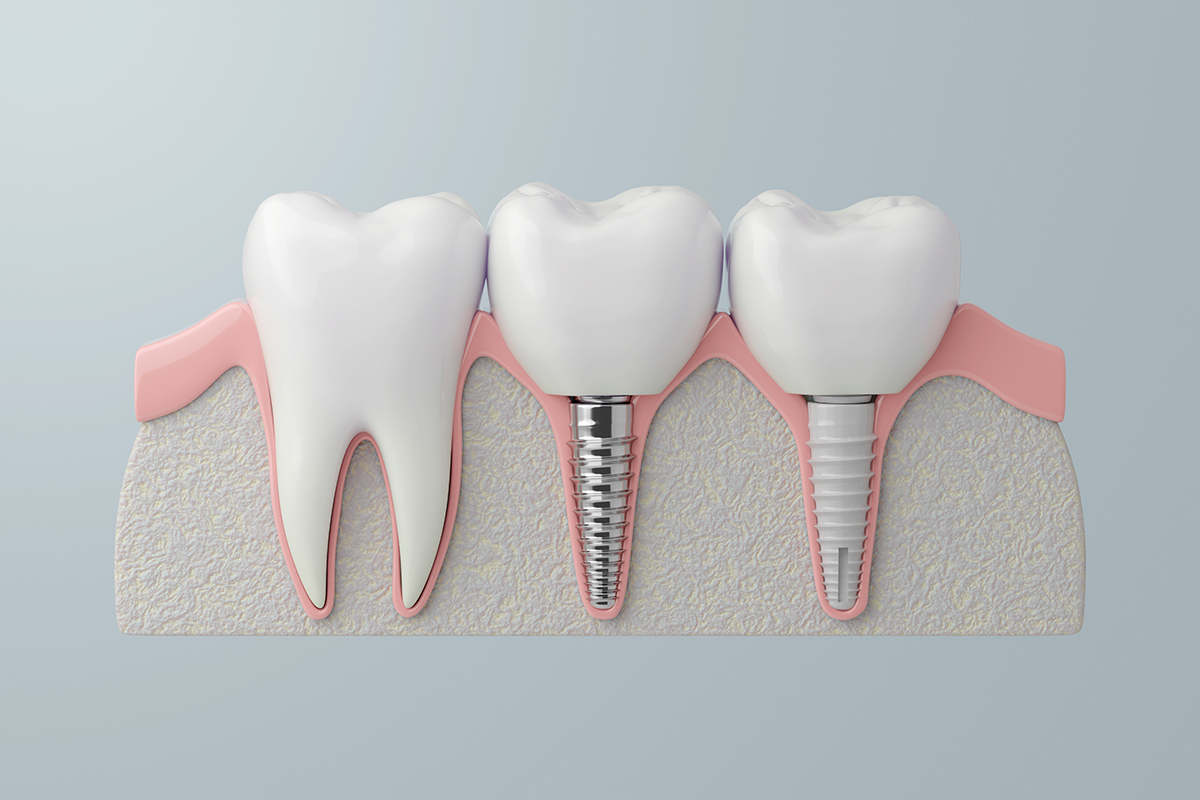 Mini-Implantate